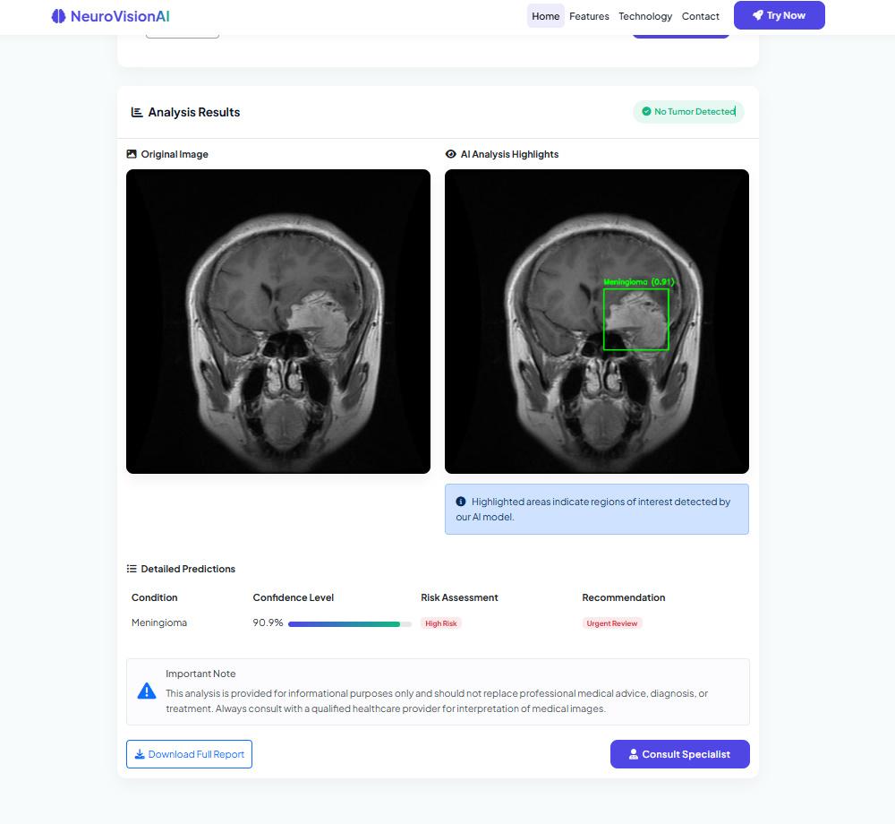 NeuroVision AI MRI analysis results